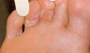 Loit Dermaid le haghaidh mycosis coise