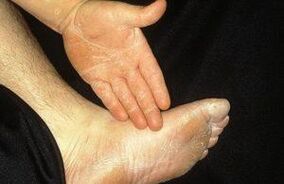 Léirítear foirm mycosis scriosta trí scamhadh