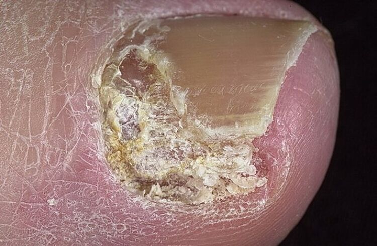 Cineálacha Onychomycosis