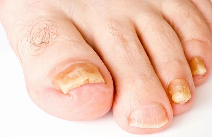 toenails buí mar gheall ar fungas