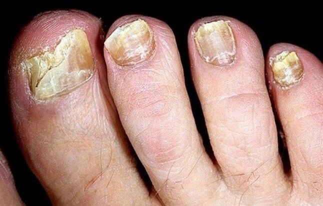 fungas ar toenails